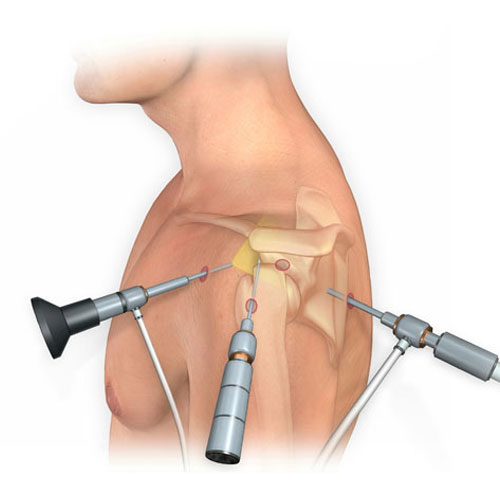 Shoulder Arthroscopy