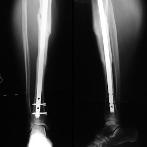 Non union fracture treatment